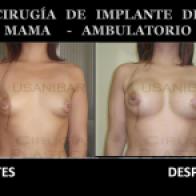 implantes de mama susanibar