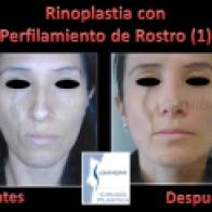 rinoplastia mas perfilamiento de rostro susanibar