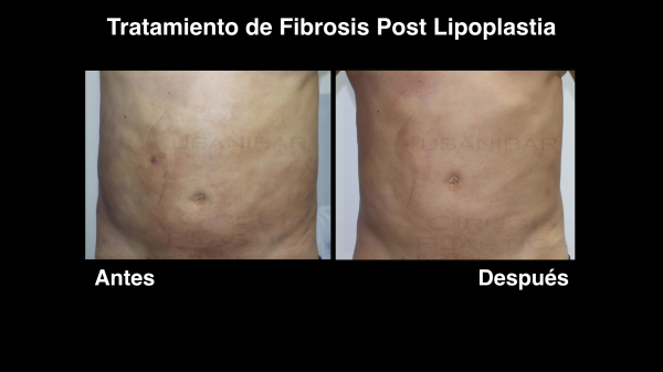 fibrosis-postlipoplastia-susanibar